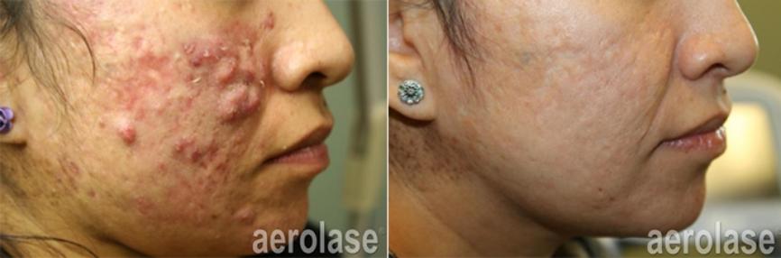 Before and after Aerolase