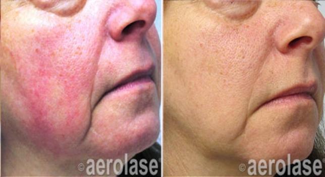 Before and after Aerolase