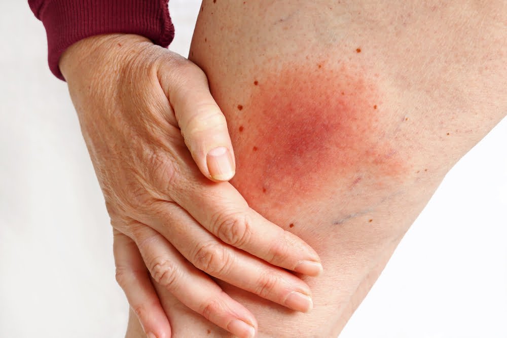Lyme Disease_Meeting Point Health