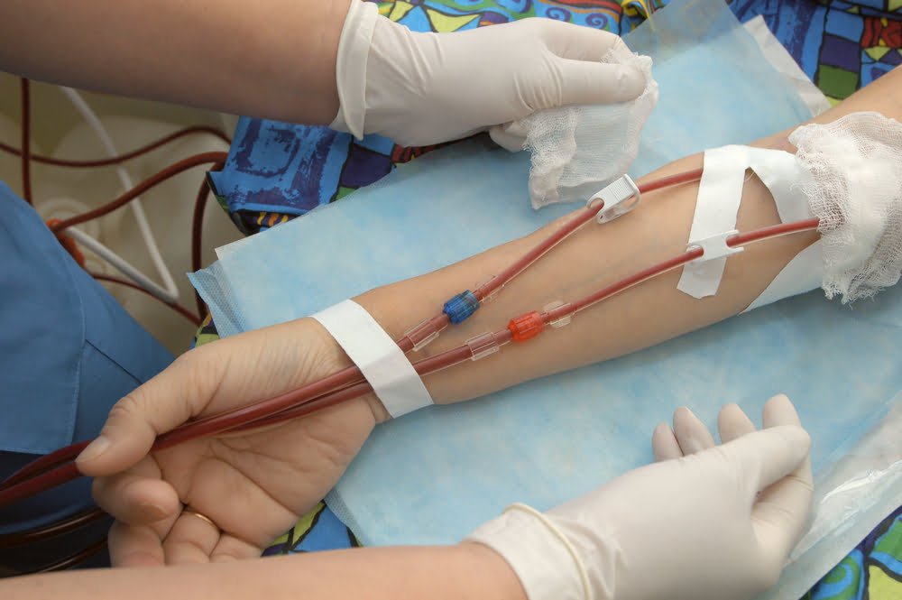 EBOO for Chronic Viral Infections