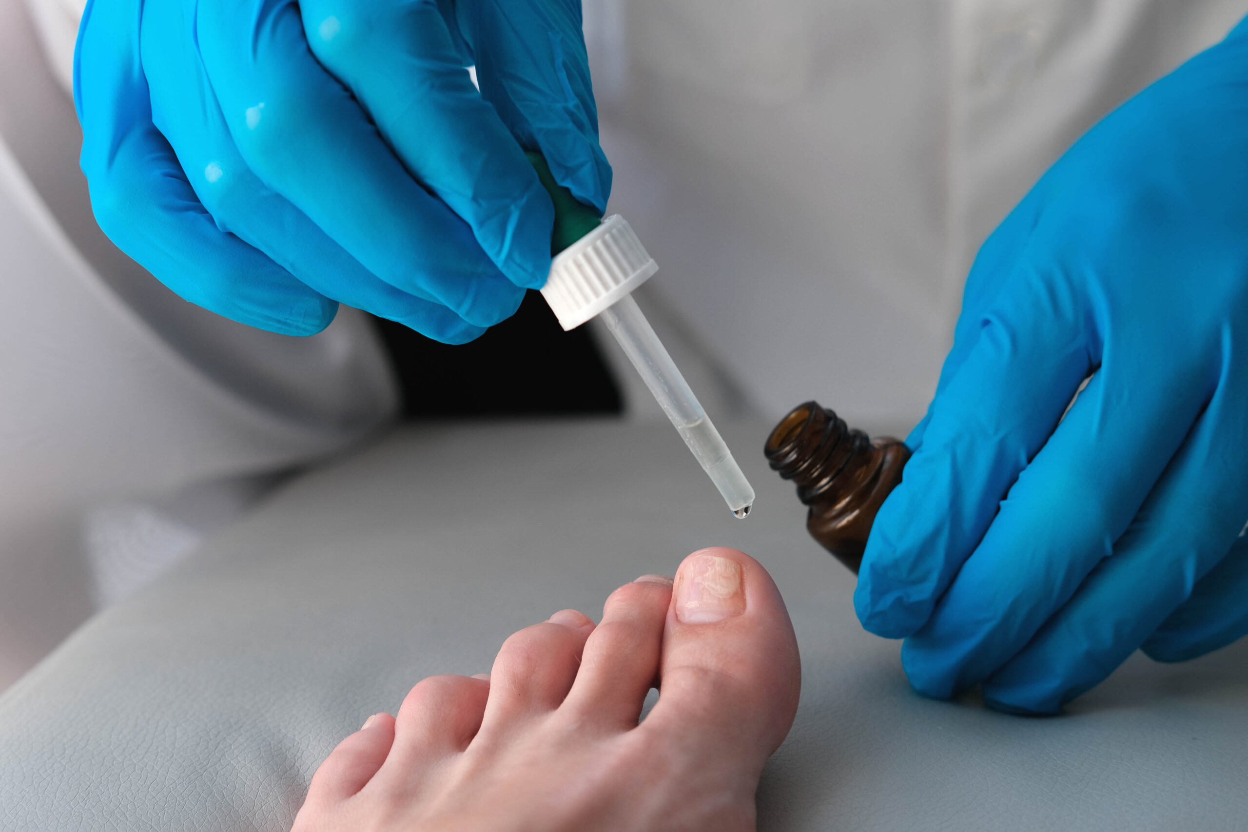 Onychomycosis - Wikipedia