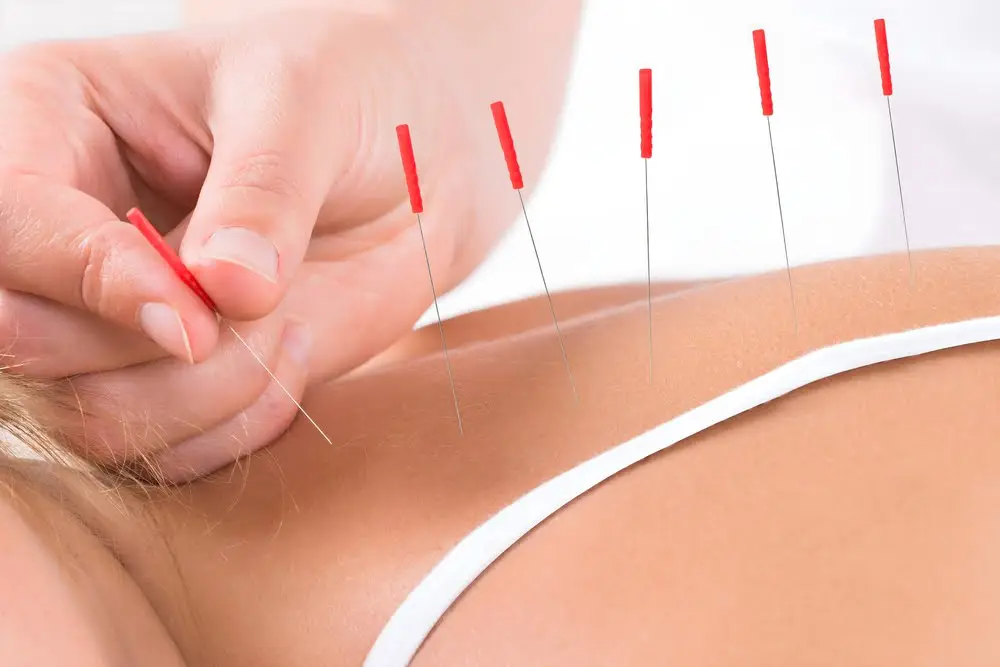 How Acupuncture Works Unlocking The Healing Power Of Needles