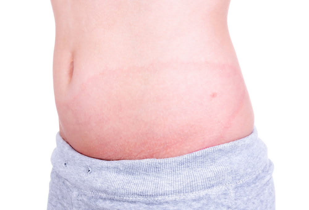 Ozone Therapy for Lyme Disease