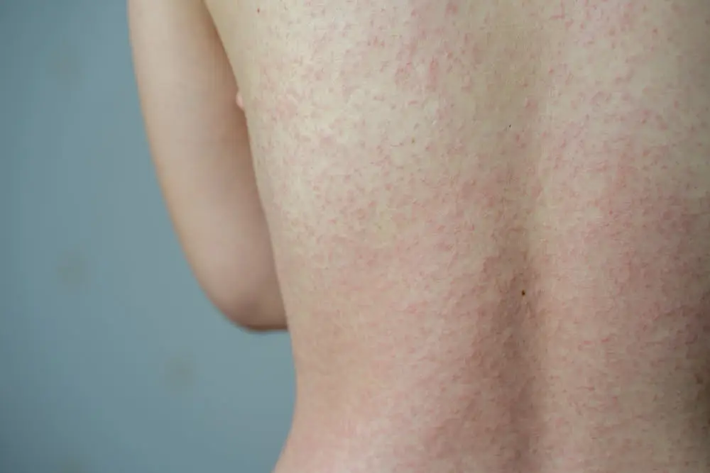 What Are Herxheimer Reactions 02